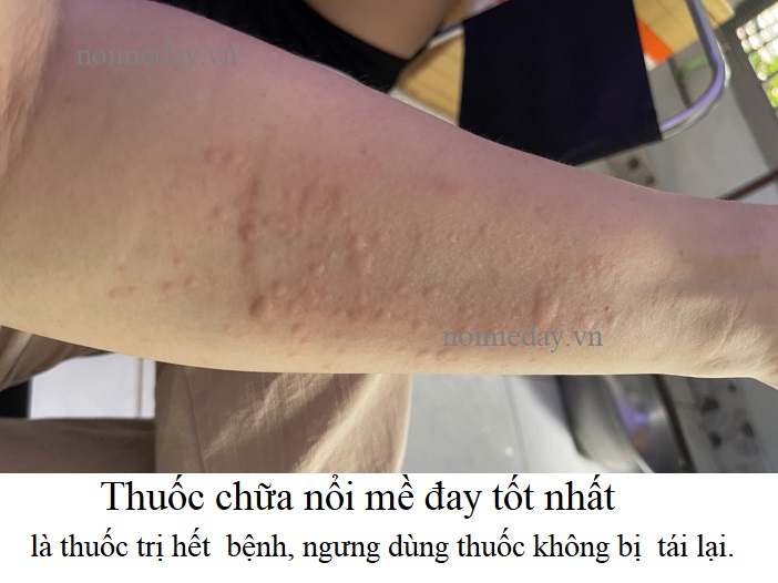 thuốc chữa nổi mề đay và ngứa